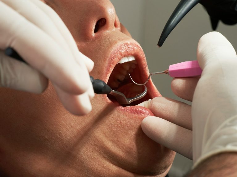 Combien de Temps Dure une Anesthésie Dentaire : Tout Savoir pour Être Prêt